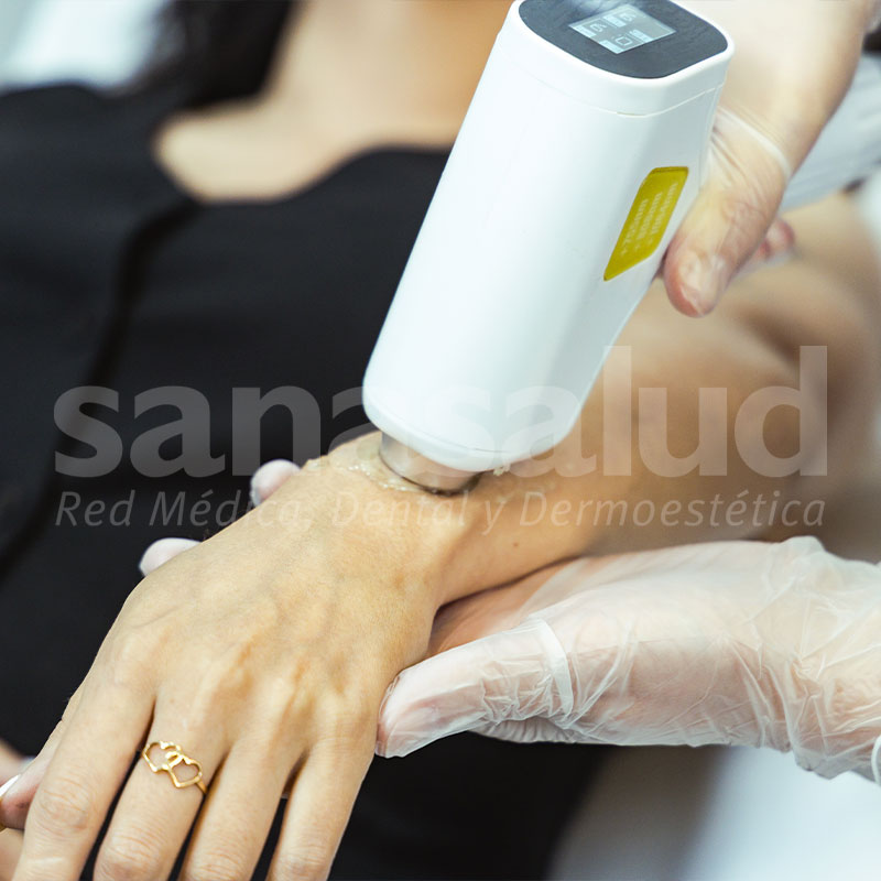 Depilacion_Laser